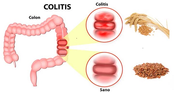 signs and symptoms ulcerative colitis