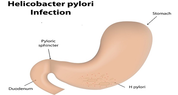 H Pylori prevention