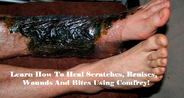 Learn How To Heal Scratches, Bruises, Wounds And Bites Using Comfrey!