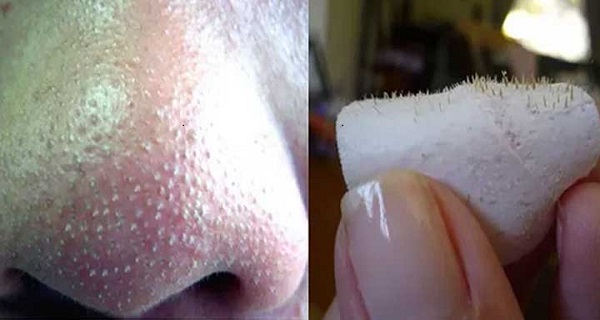 Nose blackheads