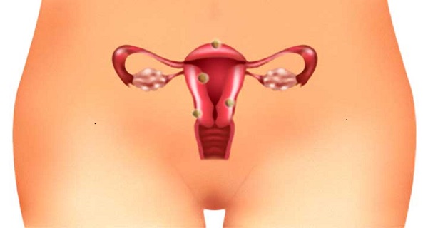 get rid of uterine fibroids naturally