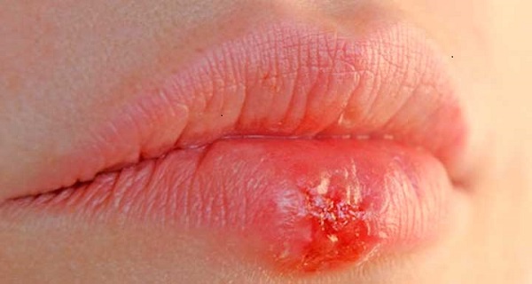 herpes on your lip