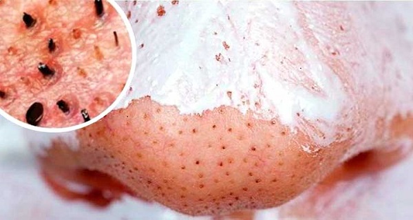 how to eliminate blackheads on nose