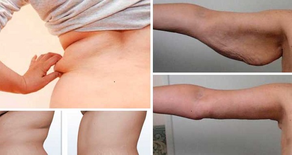 how to get rid of flabby arms after weight loss