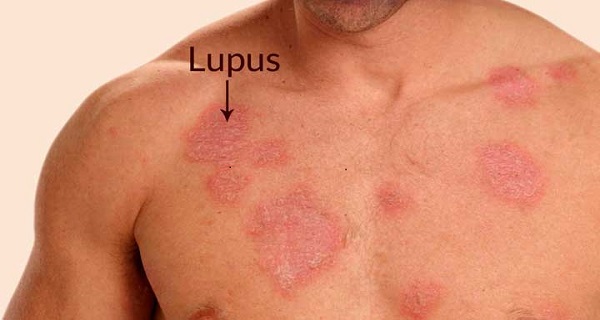 lupus skin rash on body
