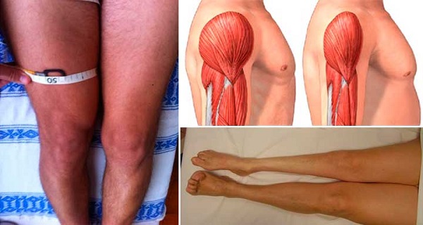 muscle atrophy disease