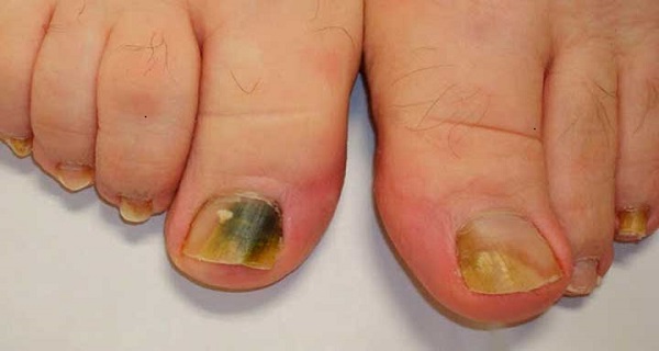 nails with fungus