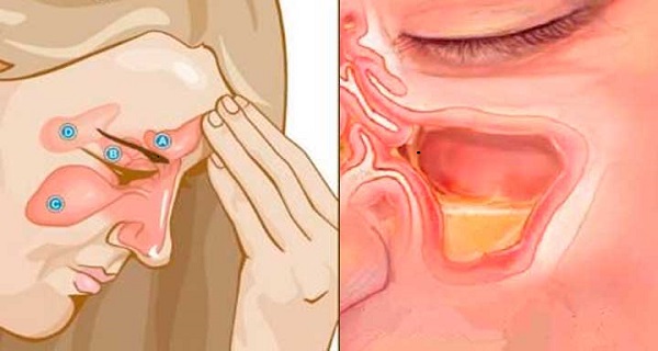 relieve sinus congestion