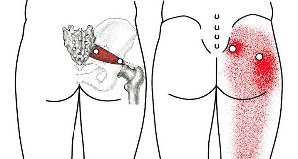 sciatica back pain causes