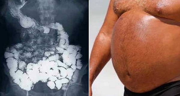 This Treatment For Swollen Stomach Will Change Your Life ...