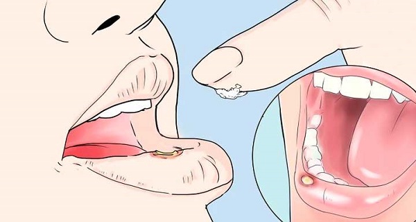 viral mouth ulcers