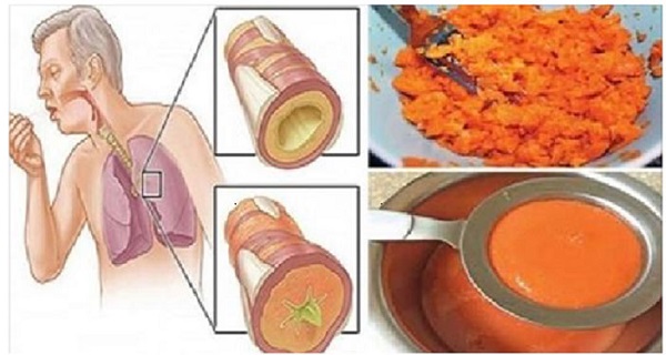 Learn How To Stop Chesty Cough And Phlegm Detoxifying The Lungs With This Natural Syrup