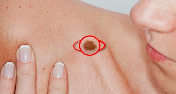 moles that can develop into malignant melanoma