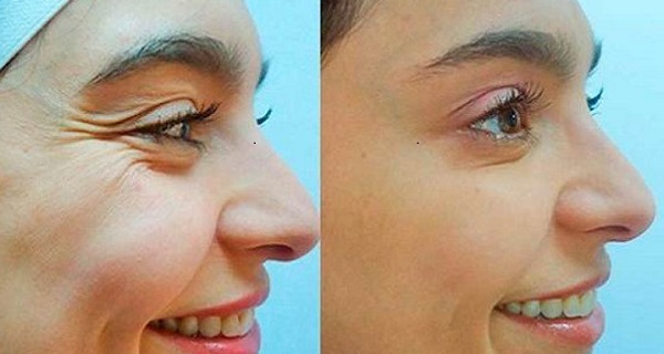 Eliminate Saggy Skin Around Eyes Using A Completely Natural Face Mask!