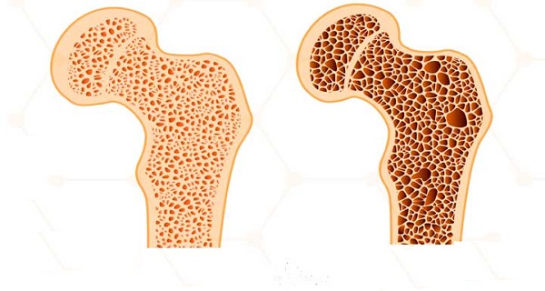 signs and symptoms for osteoporosis