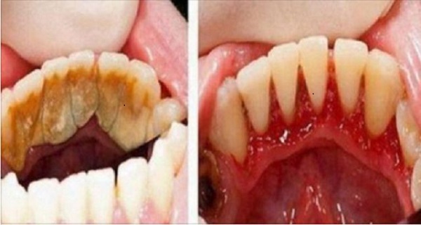 Get Rid Of Tartar Between Teeth Easily And Naturally Using This!