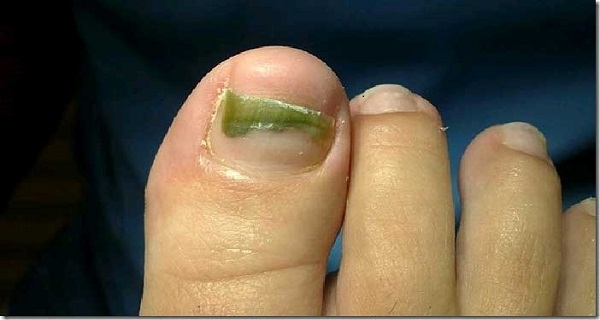 toe fungus pain