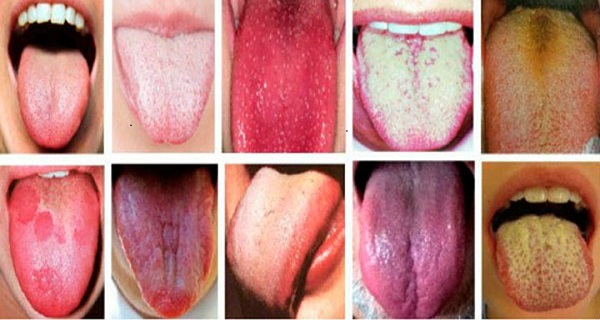tongue colour chart