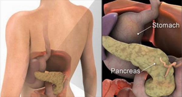 Symptoms of advanced stage pancreatic cancer