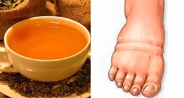 Fluid Retention Signs And Natural Solutions – 4 Homemade Remedies!