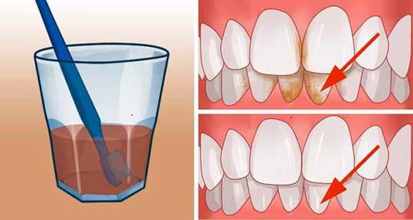 get rid of tooth decay naturally