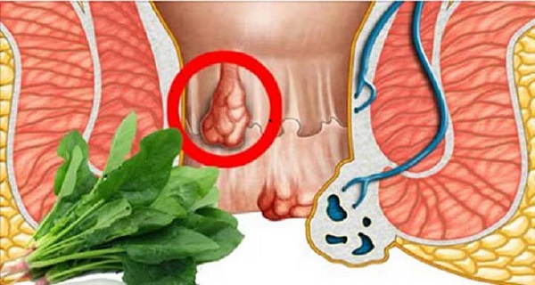 how cure hemorrhoids the natural way