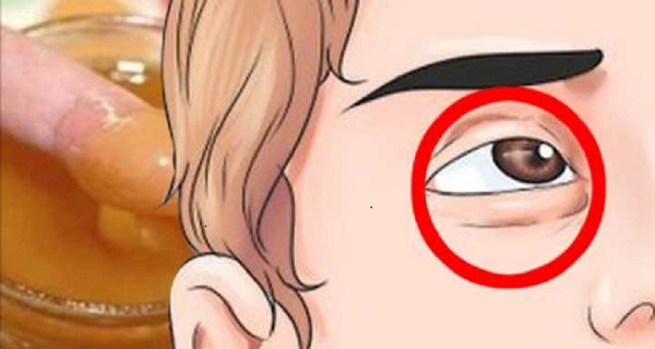 how to remove dark circles in 5 days