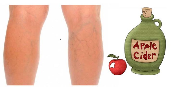 severe varicose veins