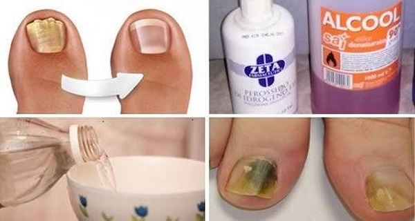 vinegar foot soak for toenail fungus