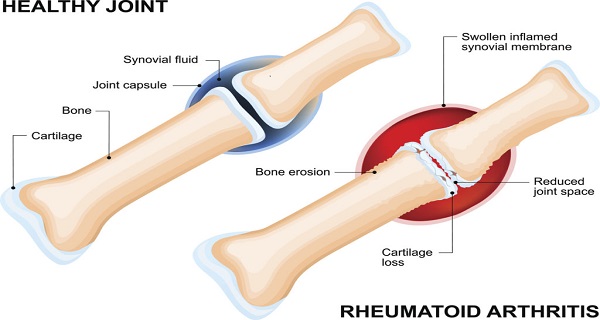 Alternative rheumatoid arthritis treatment