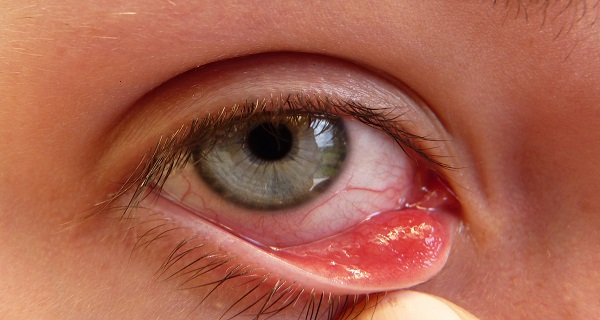 an infected stye in eye