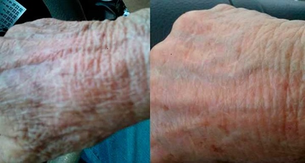 get rid of wrinkles on hands