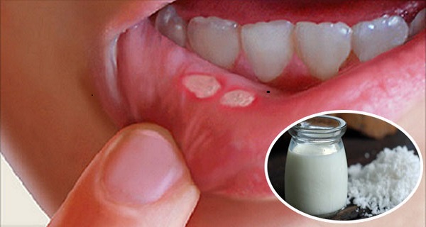 how to get rid of a mouth ulcer