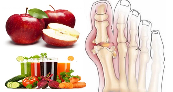 how to relieve pain from gout in foot