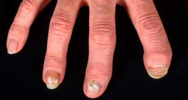 infected fungal toenail