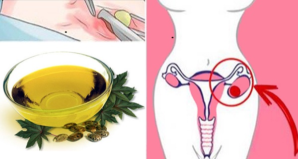 removal of ovarian cysts