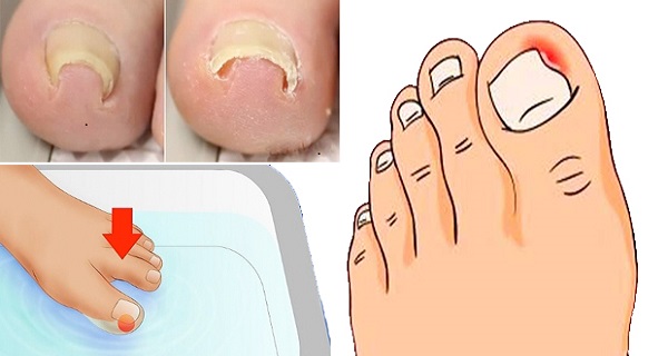 removing an ingrown toenail
