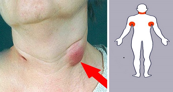 swollen lymph nodes home remedies