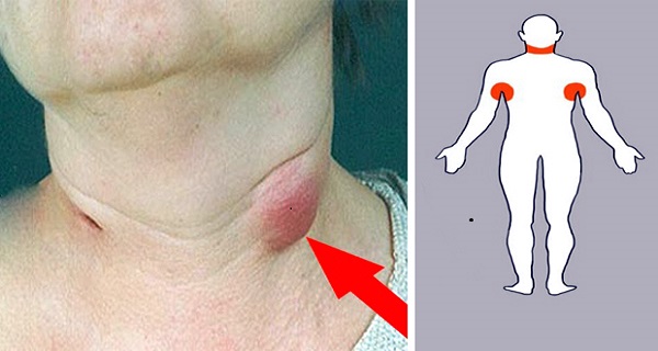 swollen lymph nodes in groin female pictures