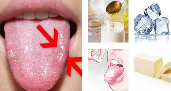 How to cure a burnt tongue