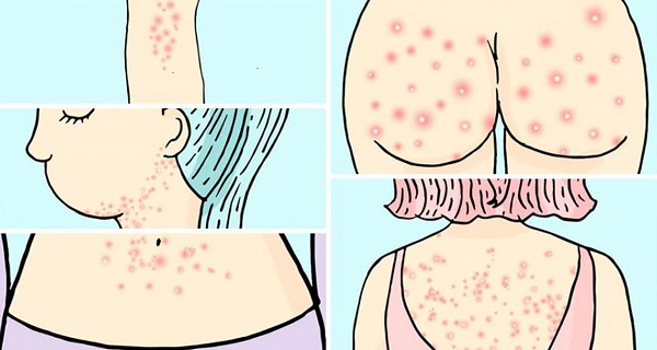 Why you have acne in certain places