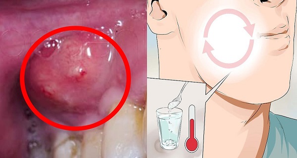 abscess tooth removal