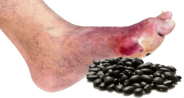 causes of diabetic foot