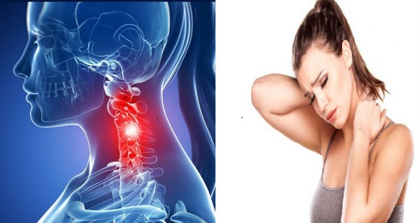 cervical spondylosis natural treatment