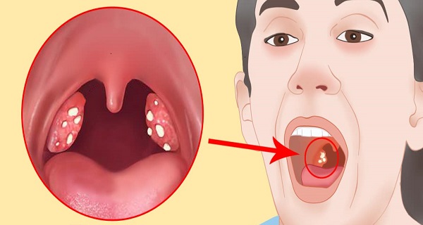 how can you get tonsil stones