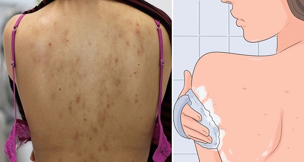 how to get acne off your back