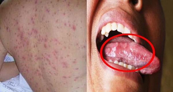 how to get rid of scarlet fever