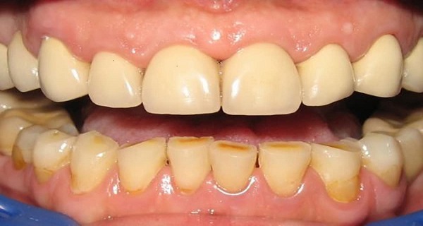 plaque buildup on teeth
