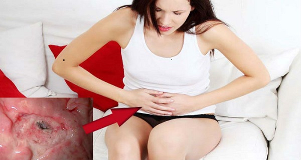 symptoms of chronic ulcer