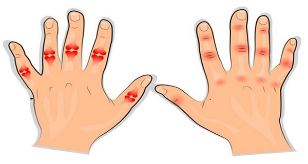 treating arthritis pain in hands